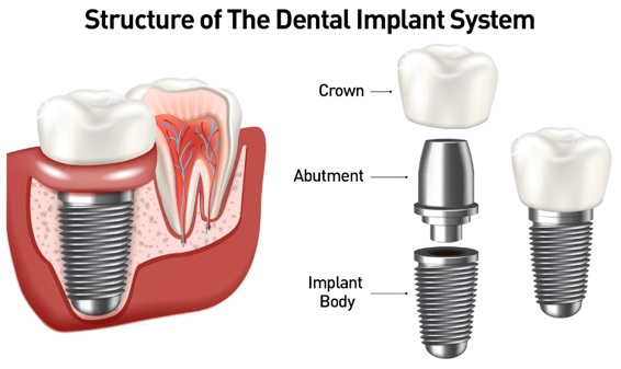 dental-implants-queens